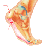 Pie con fascitis plantar